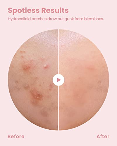 GLAM UP Hydrocolloid Acne Pimple zit flasteri - nevidljive ultra tanke tačke Cover naljepnice za lice i kožu,