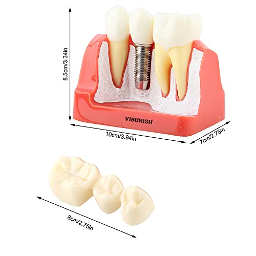 MrHugoo demonstracijski Model zuba implantat uklonjiva analiza krunski most za komunikaciju doktor-pacijent i model nastavnih zuba