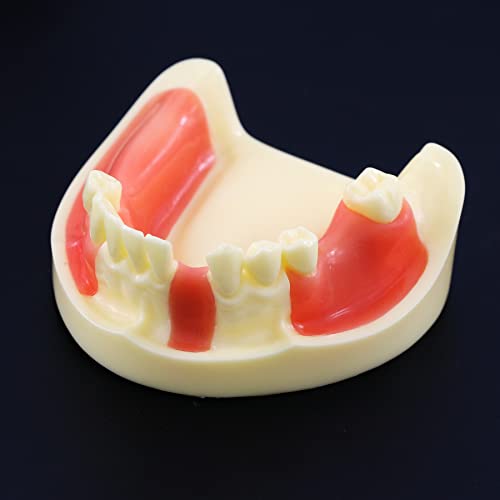 Dental Typodont Thopodont Model Implantant Vežbaj Overdenture Restaurator Demo za studij učenje