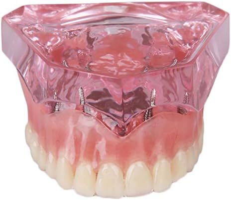 KH66ZKY Overdenture implantati Demo nastavni komplet - Dentalni model zuba - Demonstracijski model zuba za obrazovanje o pacijentu